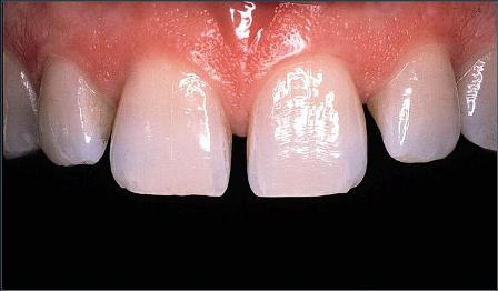 teeth with spaces